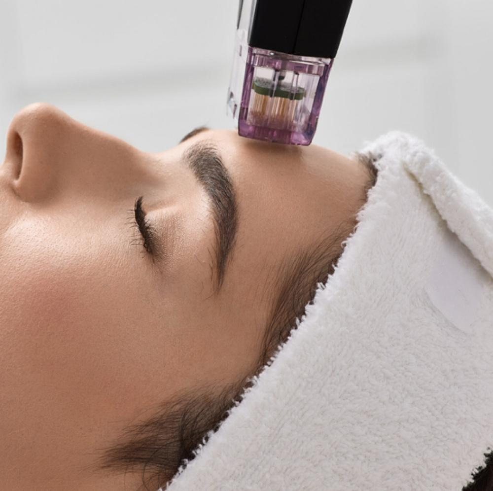 RF Microneedling at Chatuge Med Spa & Fitness in Hiawassee, GA