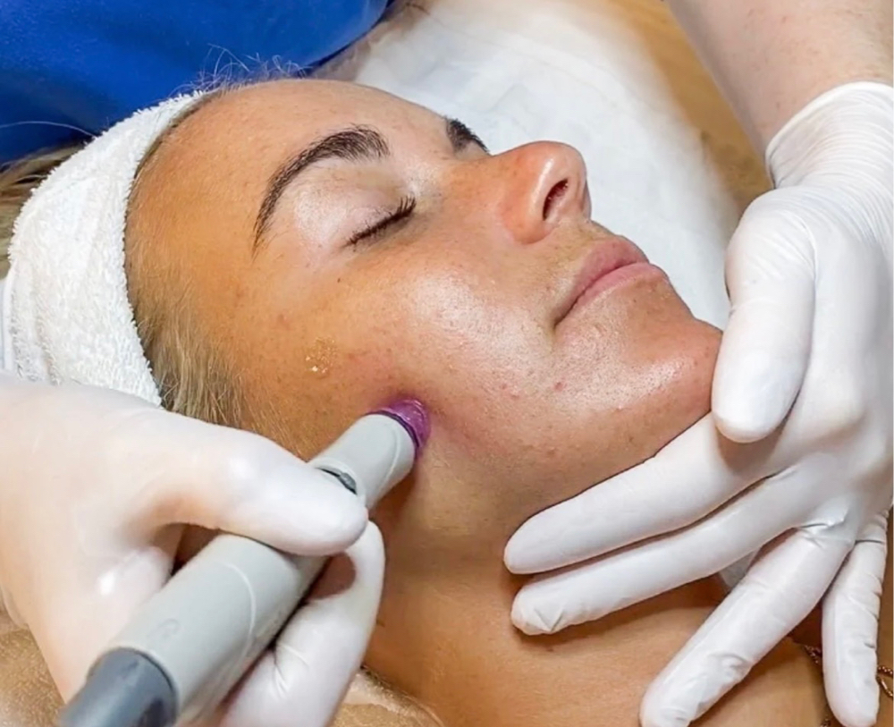 Microdermabrasion