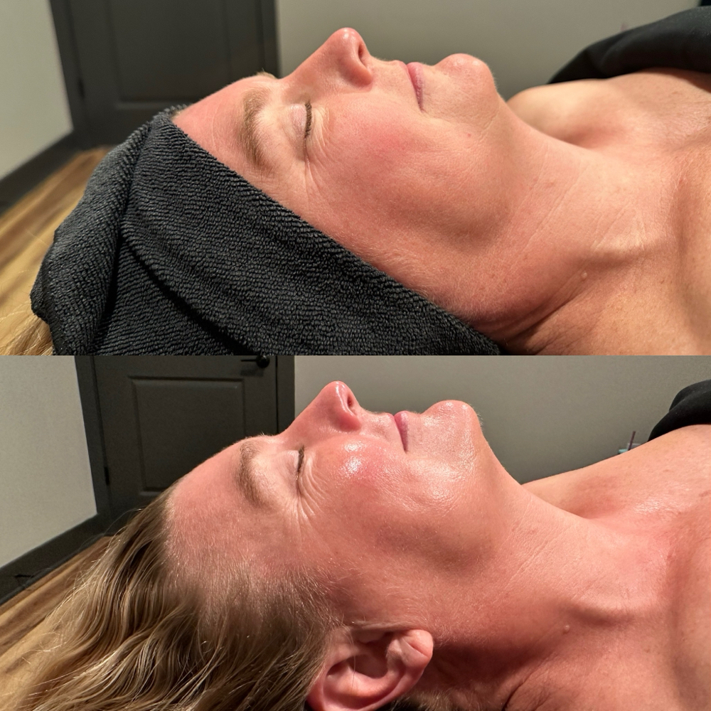 SWiCH Rejuvenation Facial