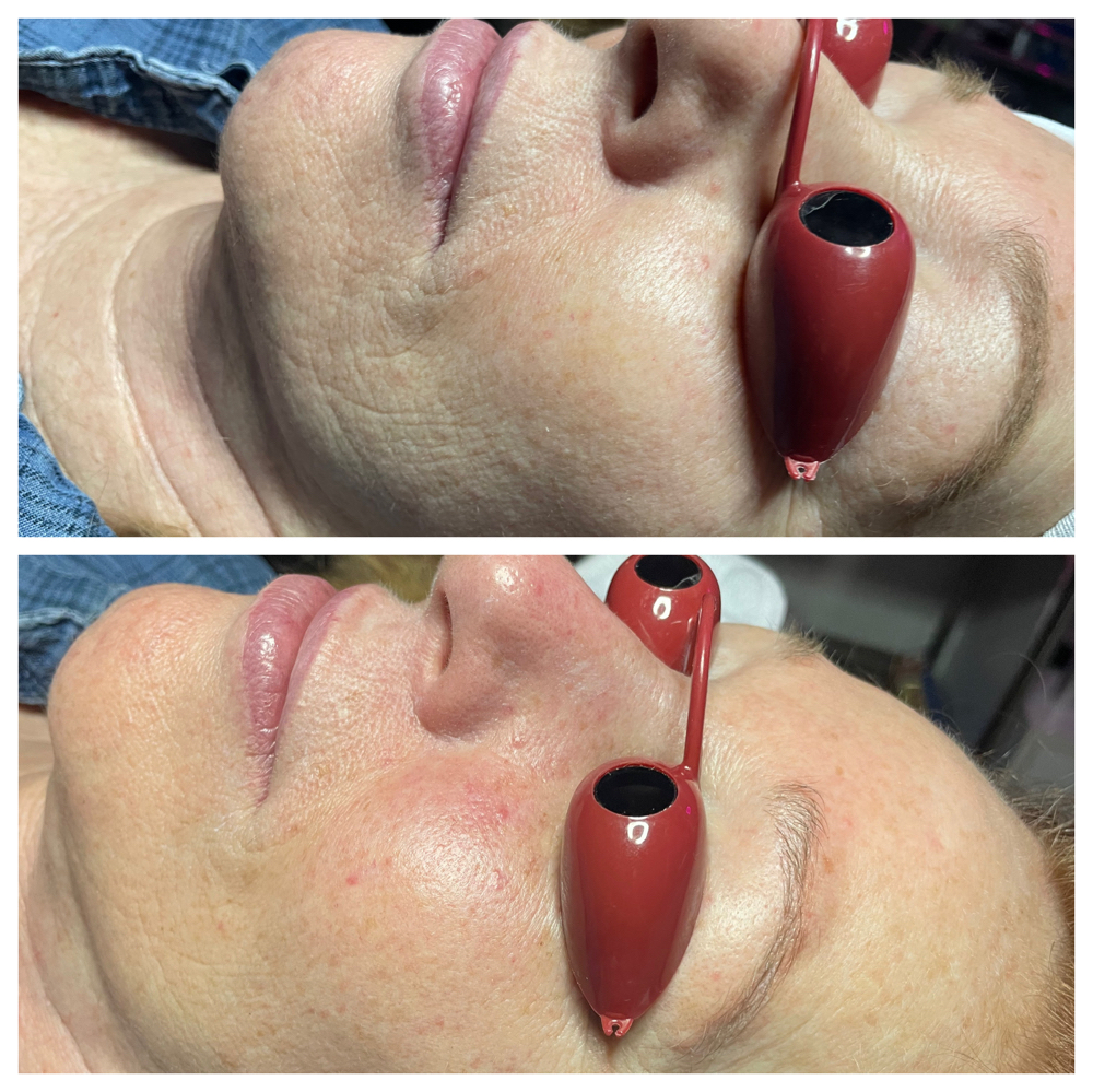 Nano Or Micro-needling