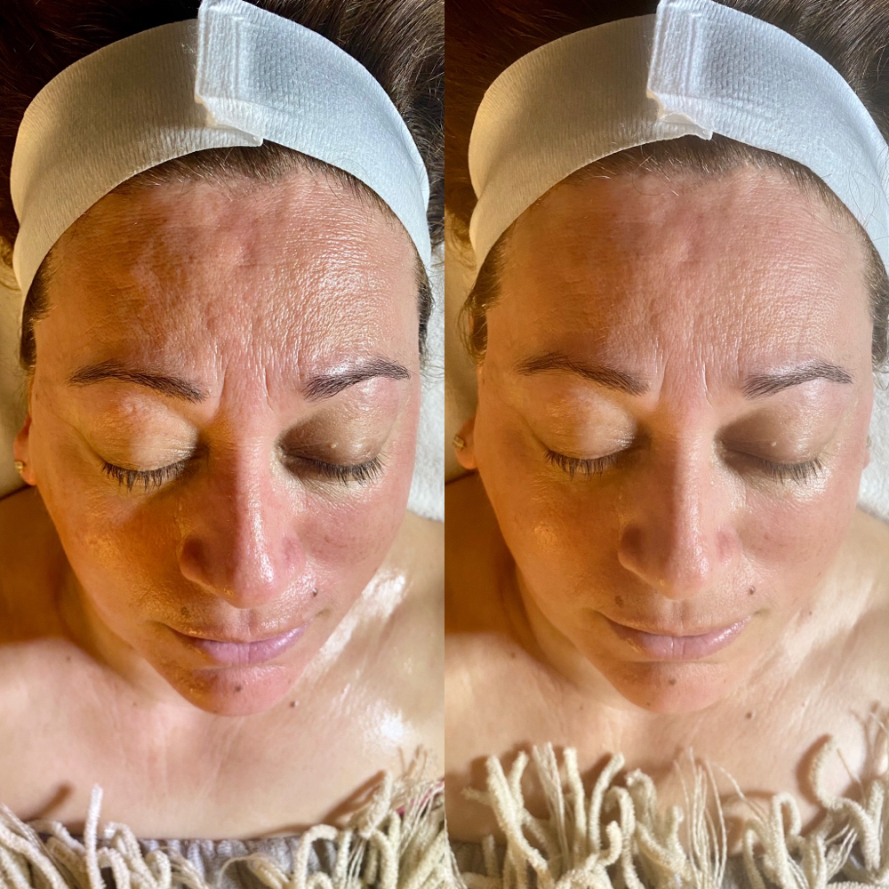 Lymphatic Drainage Facial
