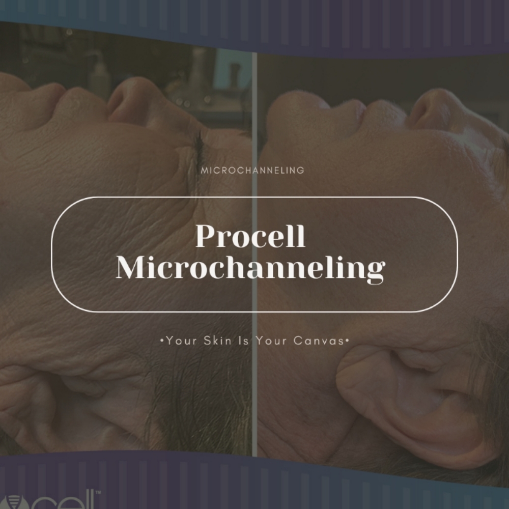 Procell 1 Treatment at Face Palette Aesthetics in Franklin, WI