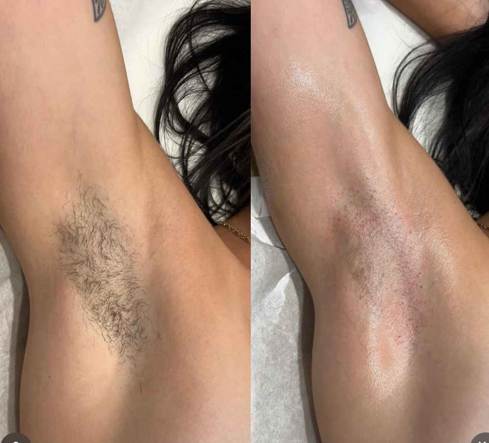 Underarm Wax at Dose Of Beauty in New Britain, CT