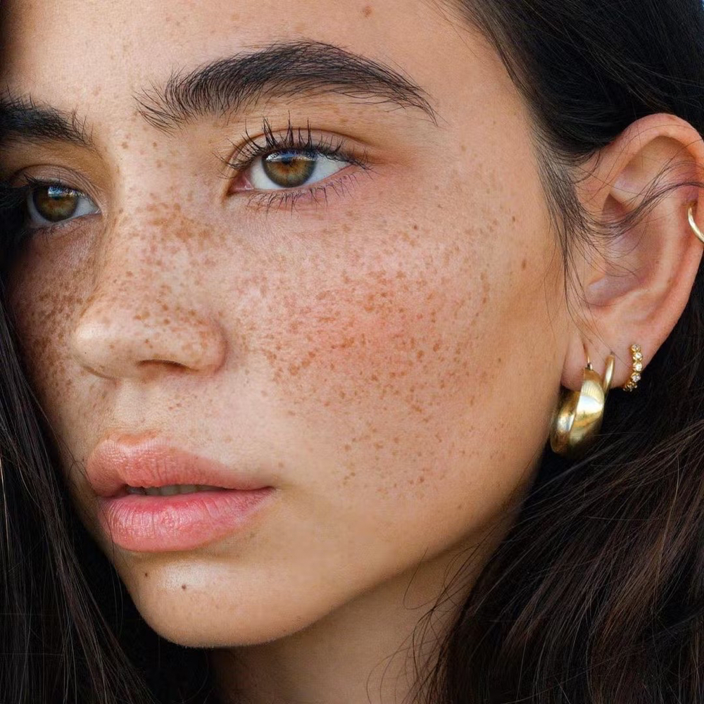 Freckle Enhancement