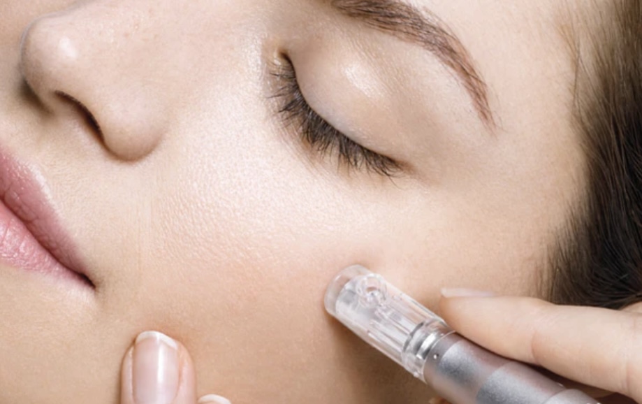 Microneedling