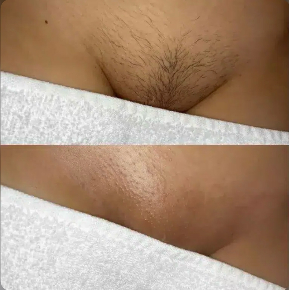 Brazillian Wax (Woman)