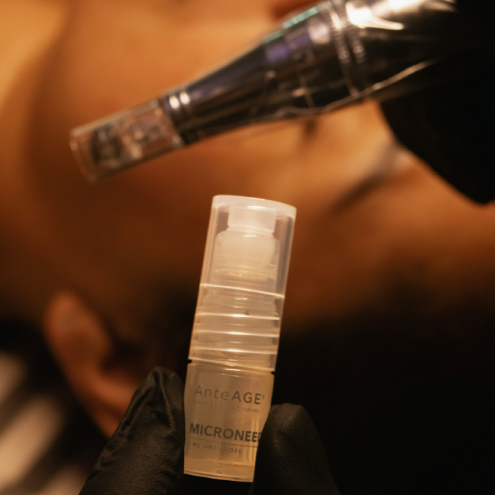 Microneedling with AnteAGE® at Holistic Skin and Massage Factory in Tucson, AZ