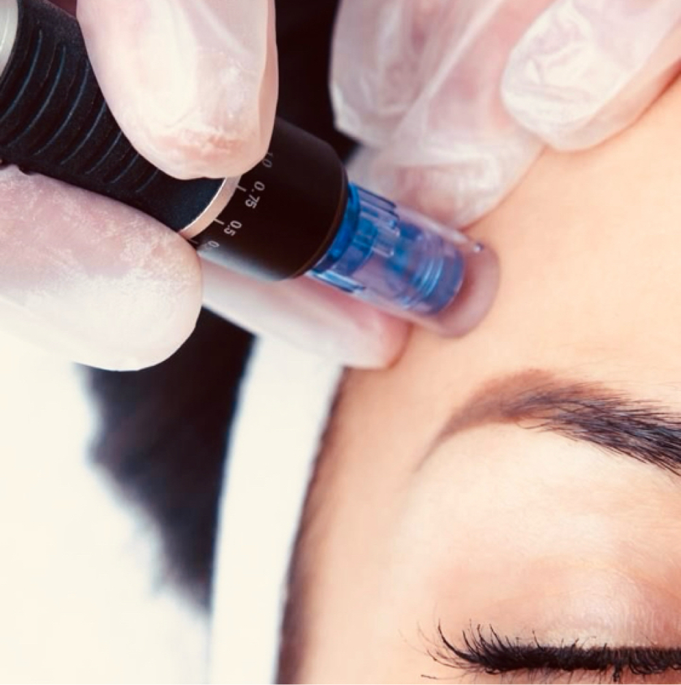 Microneedling Decolletage at The Juniper LLC in BARGERSVILLE, IN