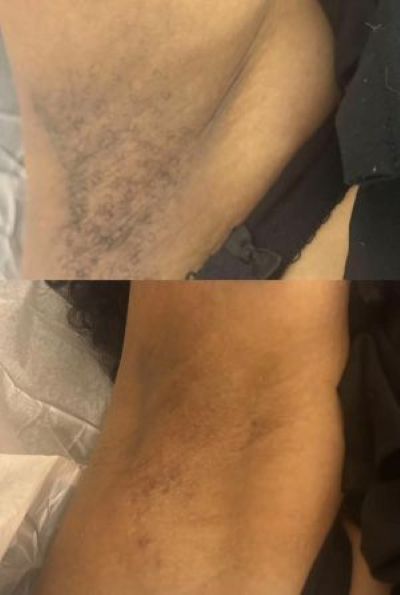 Underarm Wax