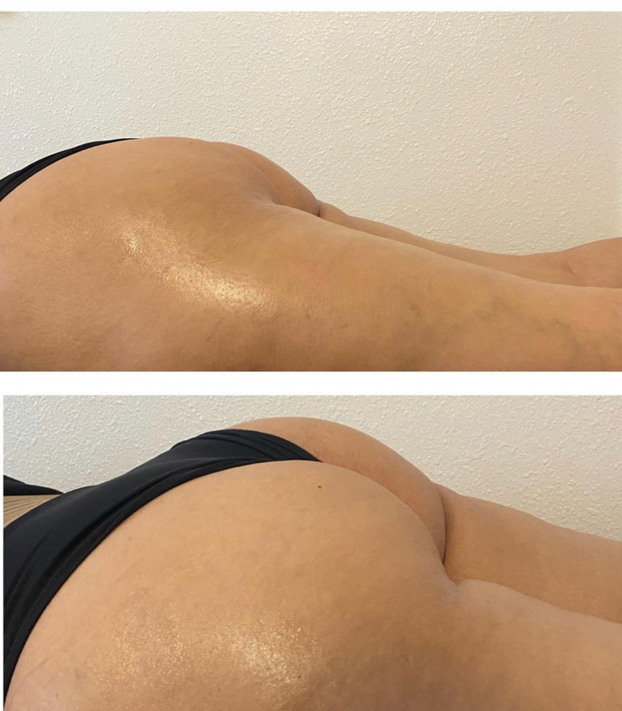 BBL W/ Cellulite Remove 3 Session
