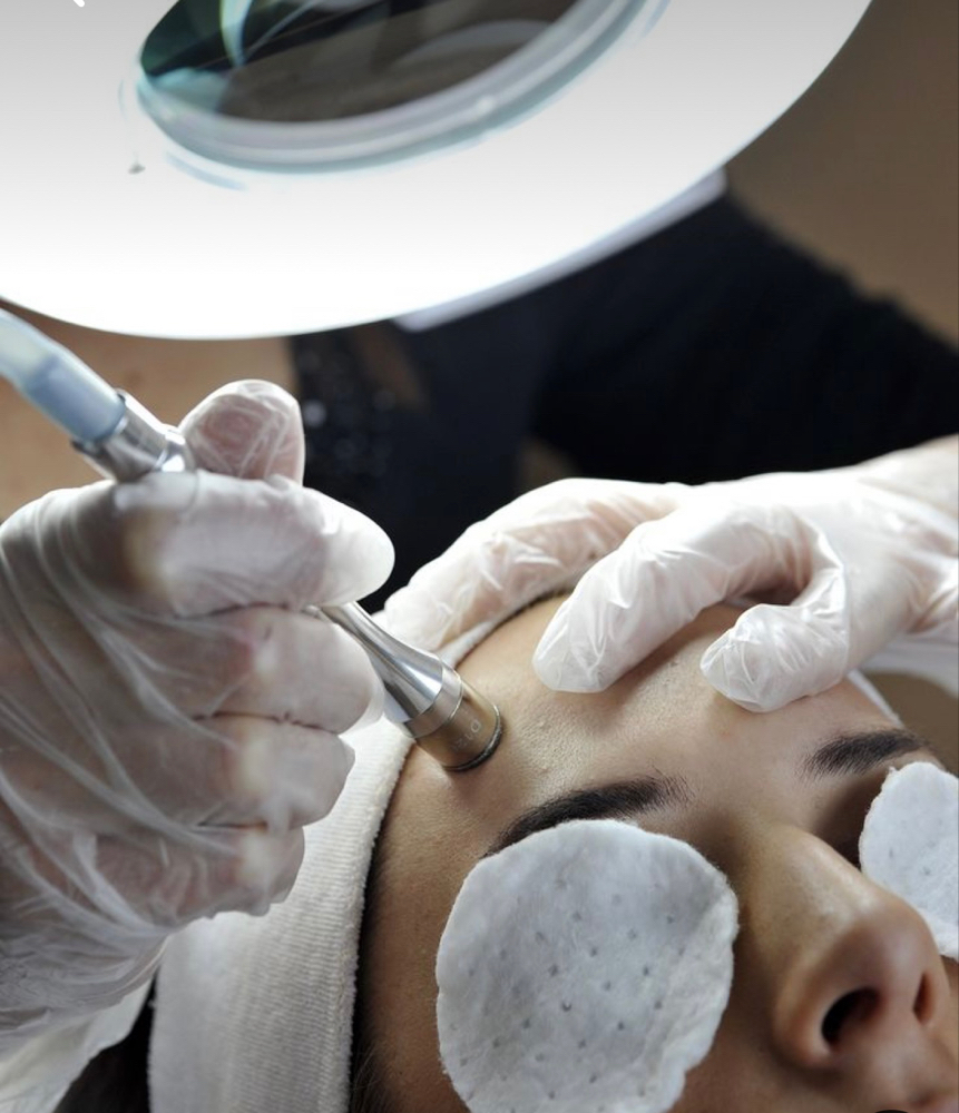 Microdermabrasion Treatment at MP Aesthetics & Beauty LLC in Foley, AL