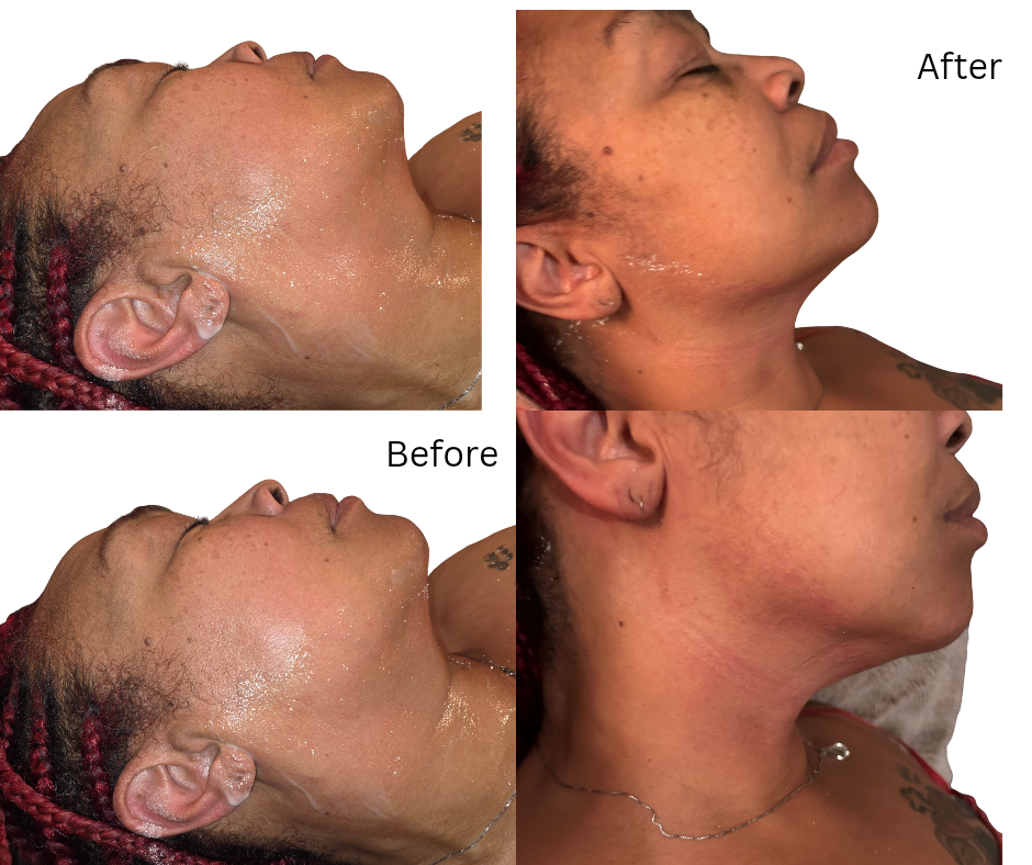 Yeso Wrap On Jawline