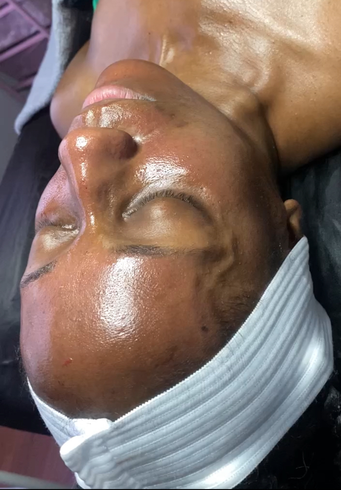 The Filter Effect (Microneedling)
