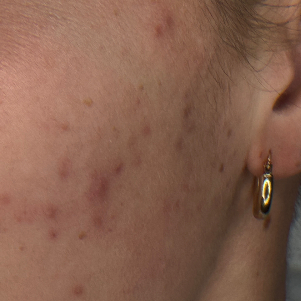 Acne Clearing Treatment In Jersey C at Pure Joi Skin in Jersey City, NJ