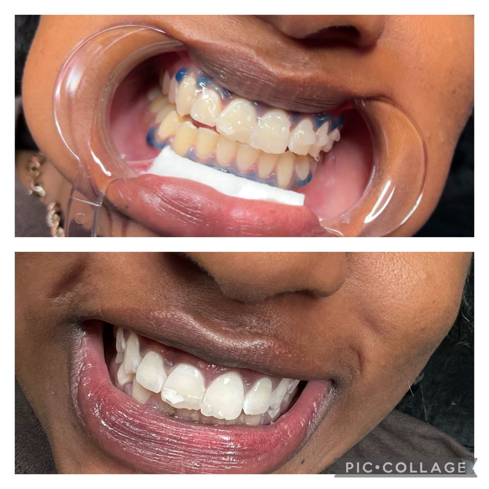 50 Min Teeth Whitening