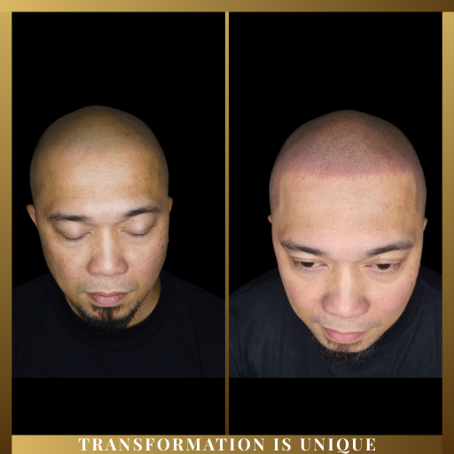 SMP Touch-Up (13–24 months)