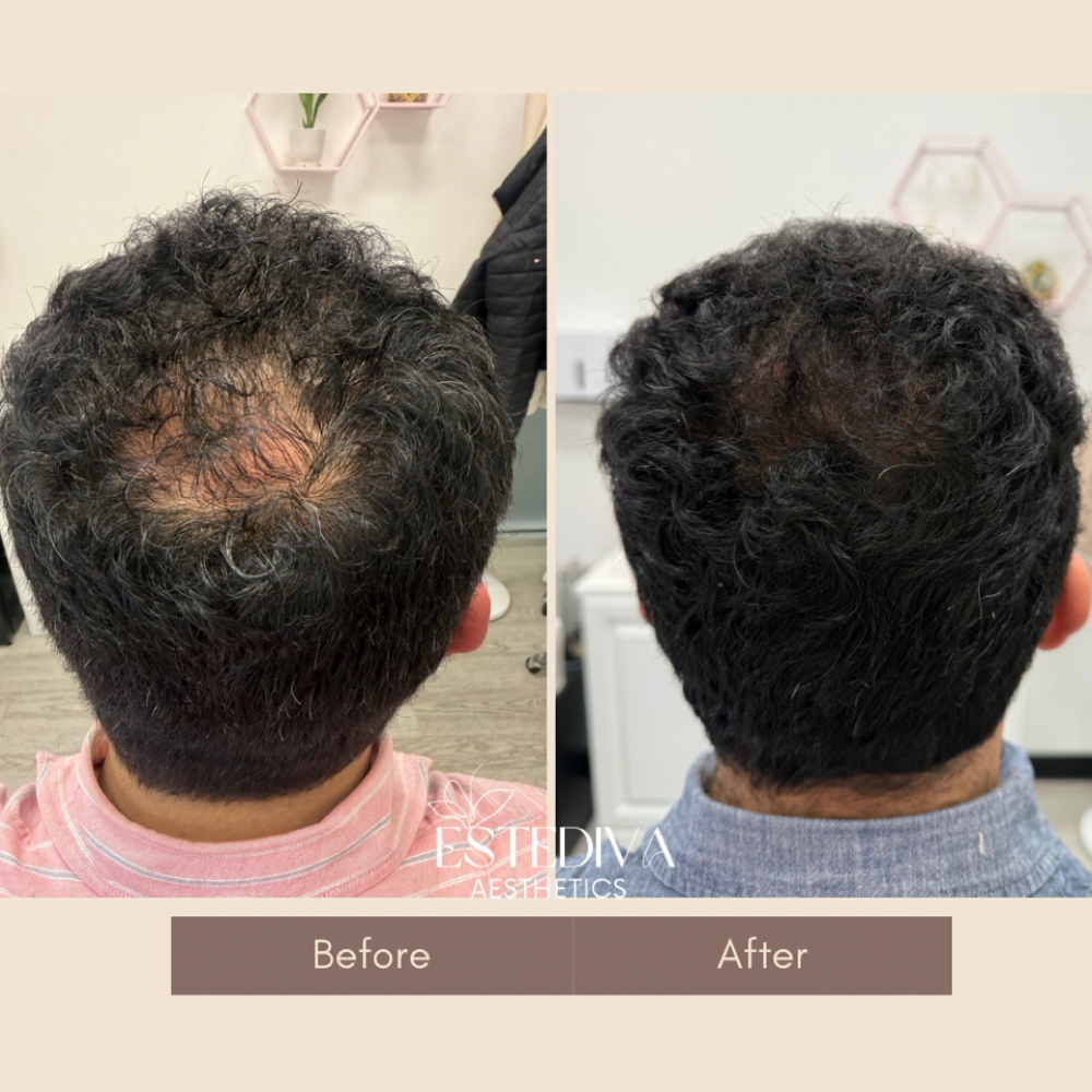 Plasma Hair Therapy with Exosomes at Estediva Aesthetics in Long Island City, NY