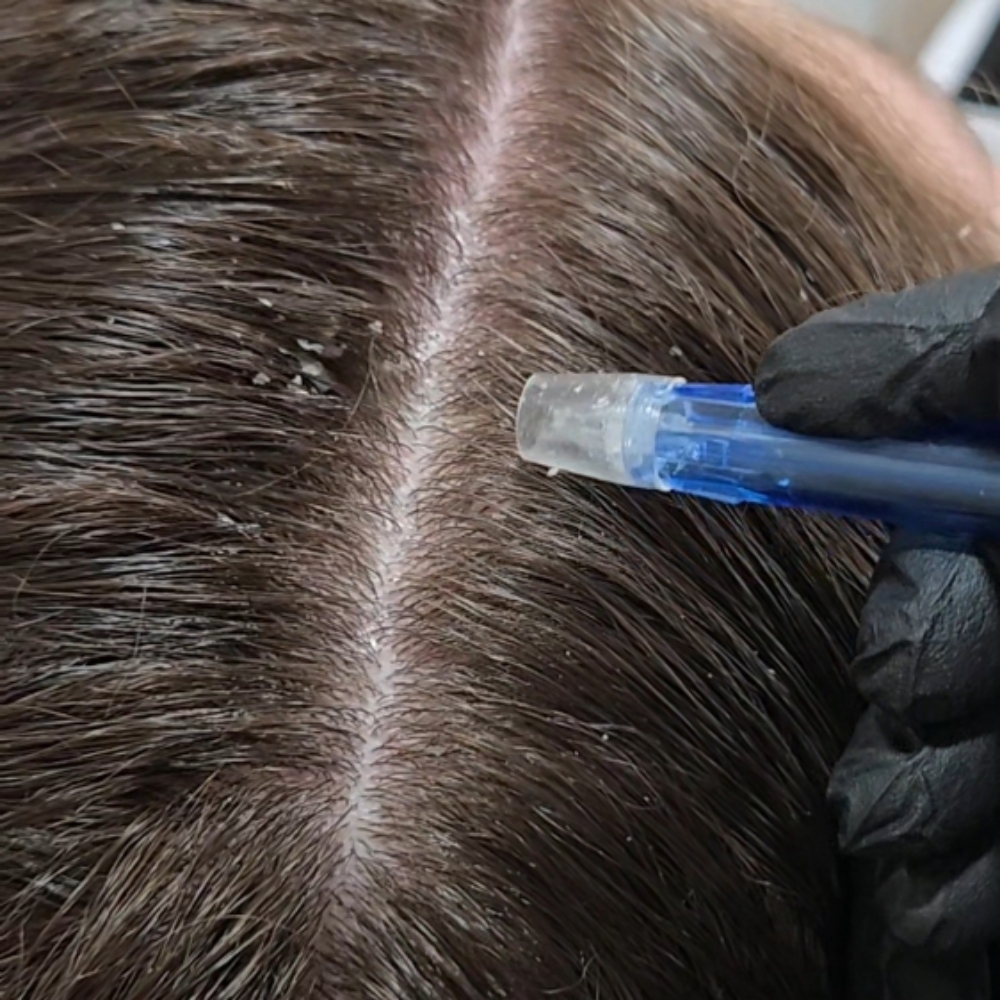 Jet Peel Scalp Therapy at Crown Therapy in Sumner, WA