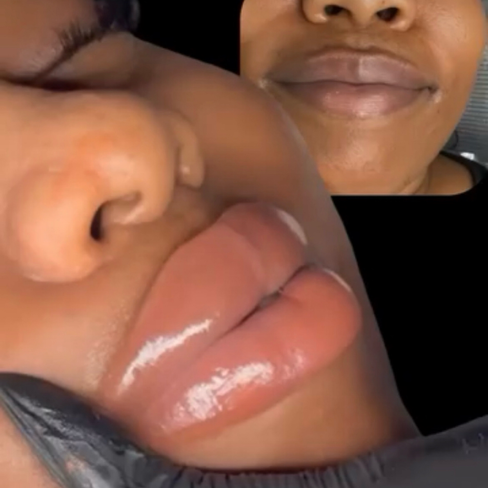 Signature Lip Neutralization  Lip N at Nakkid Skinn Studio in Marietta, GA