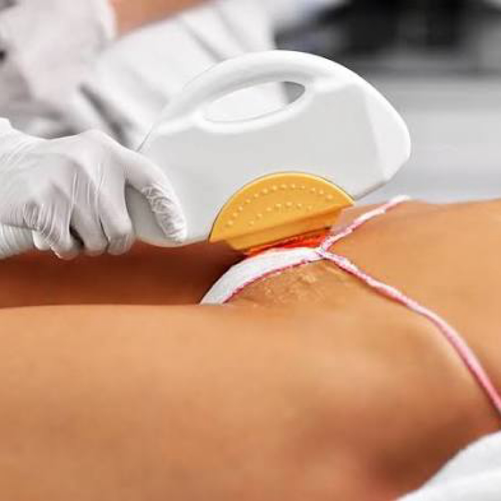 Laser Hair Removal (Bikini Area)