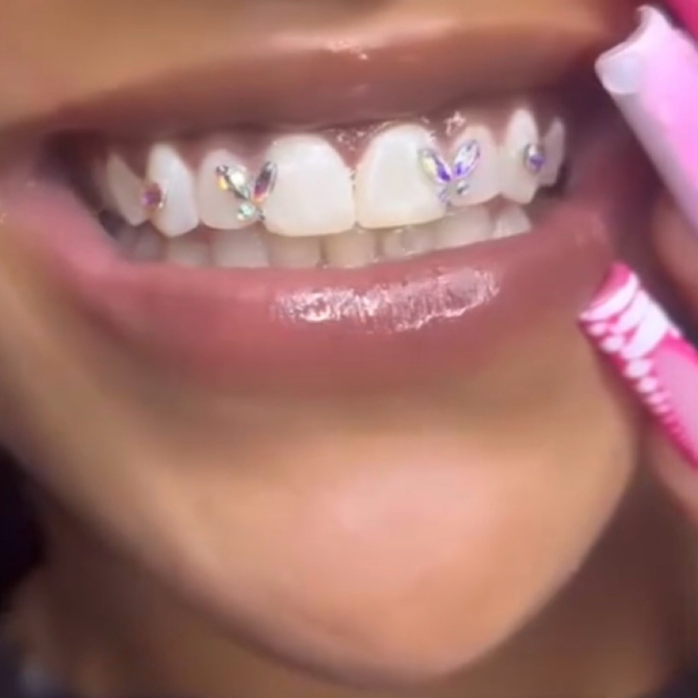 Double Butterfly Set + 2 Gems at Luxe Glow Smiles in orlando, FL