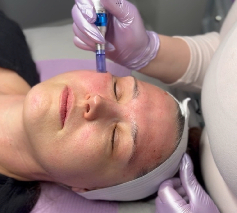 Microneedling