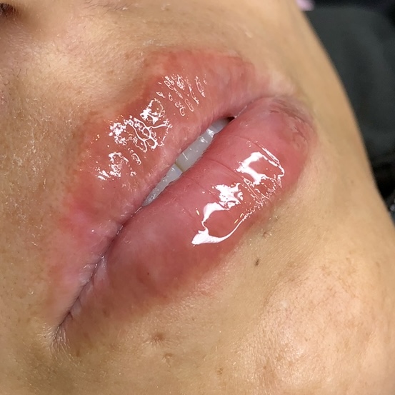 0.5ml Hyaluronic Lip Filler