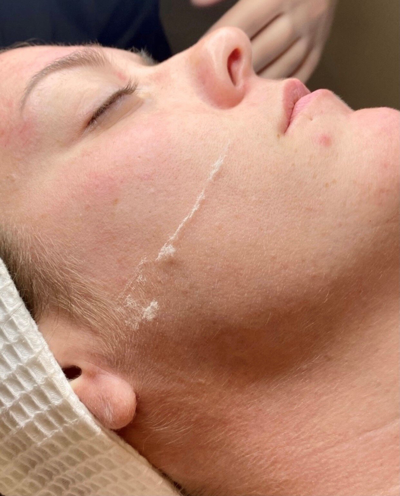 Dermaplaning
