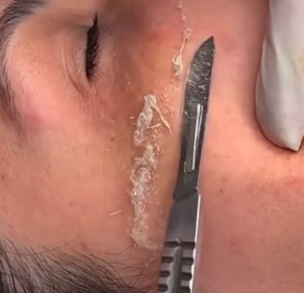 Dermaplaning