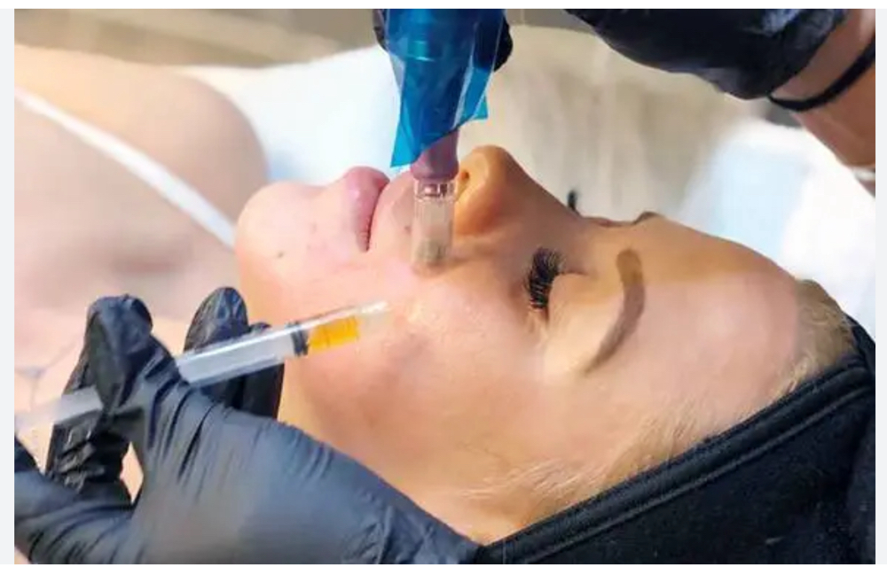 Microneedling with PRP effectively