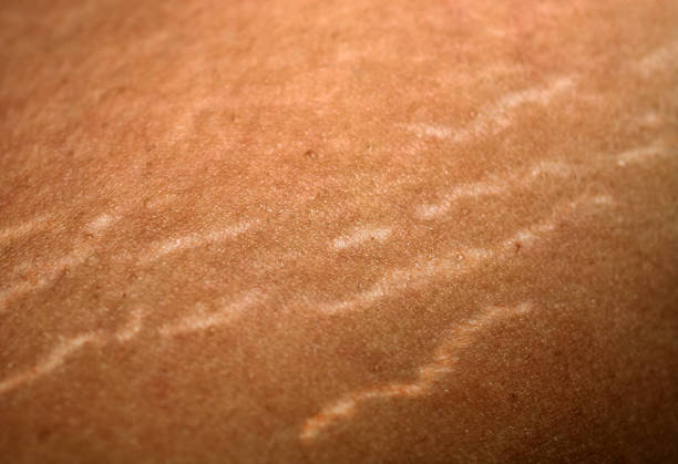 Stretmarks/Scar Color Treatment