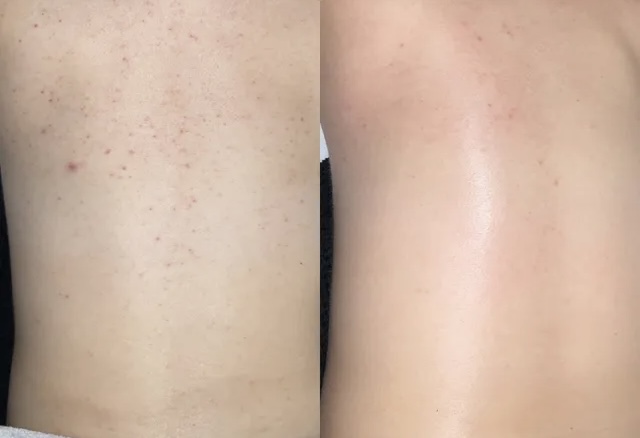 Face Reality Clear Skin Back Peel