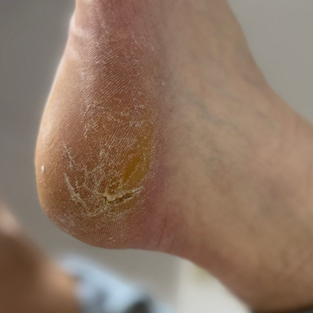 Callus Removal at Southern Oregon PEDICURE CLINIC in Medford, OR