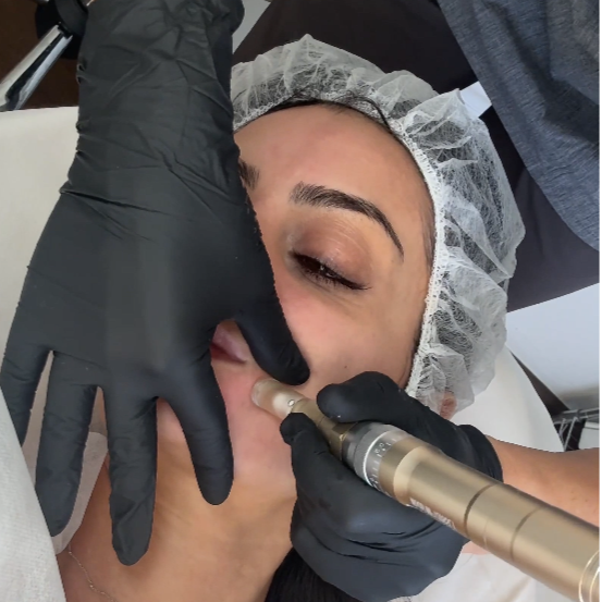 Nanoneedling 0.25 mm at Shear Beaute in Cheyenne, WY