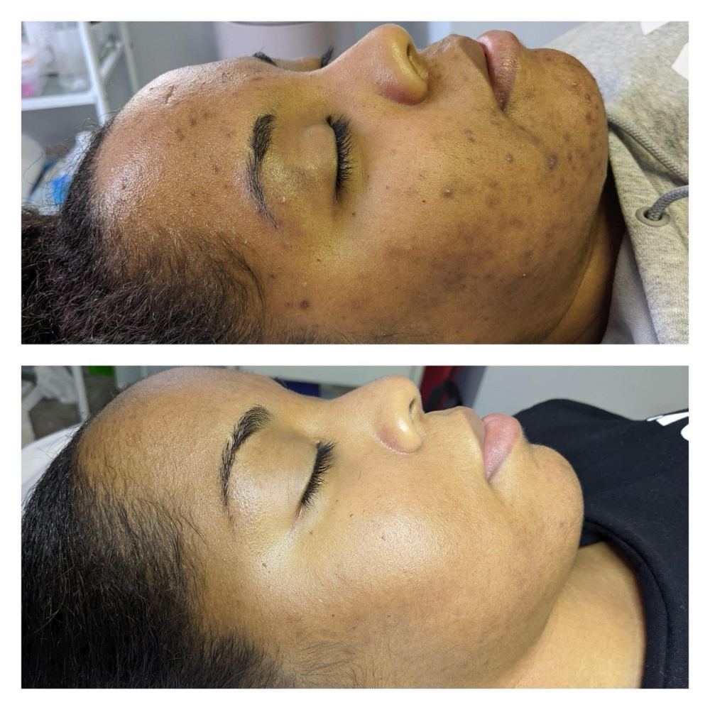 Peeling Manchas & Melasma