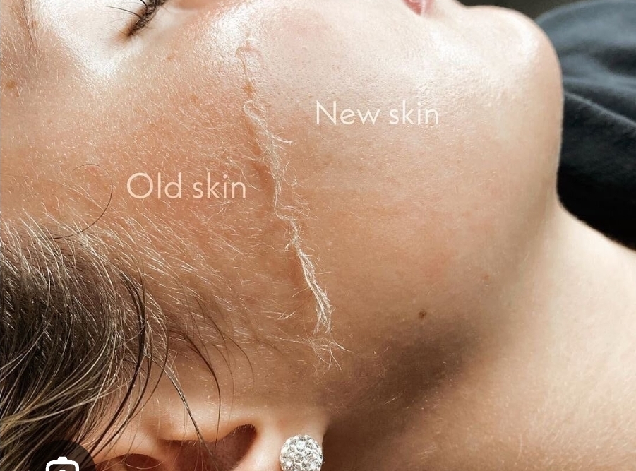Dermaplaning