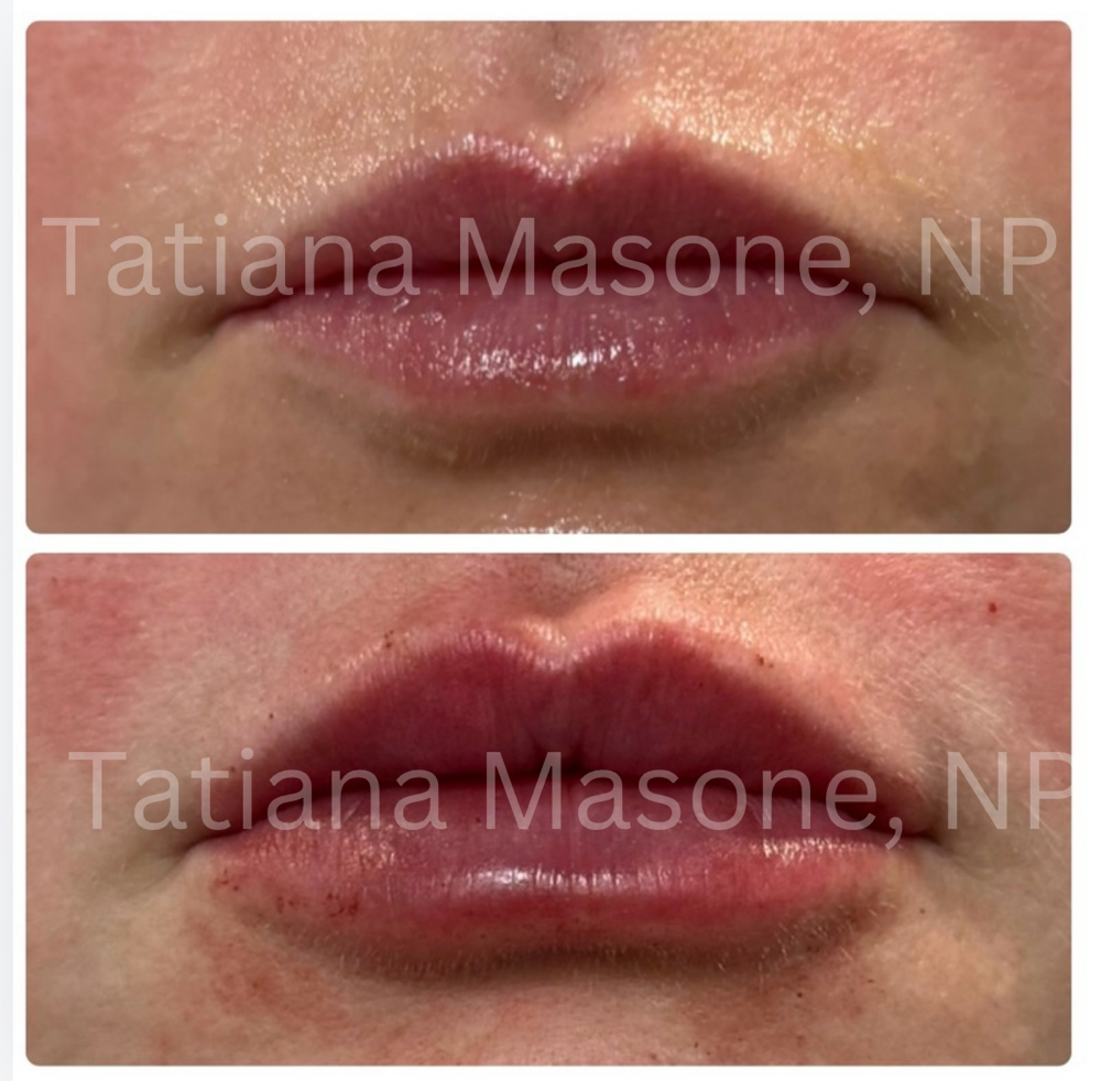 Lip Filler full Syringe