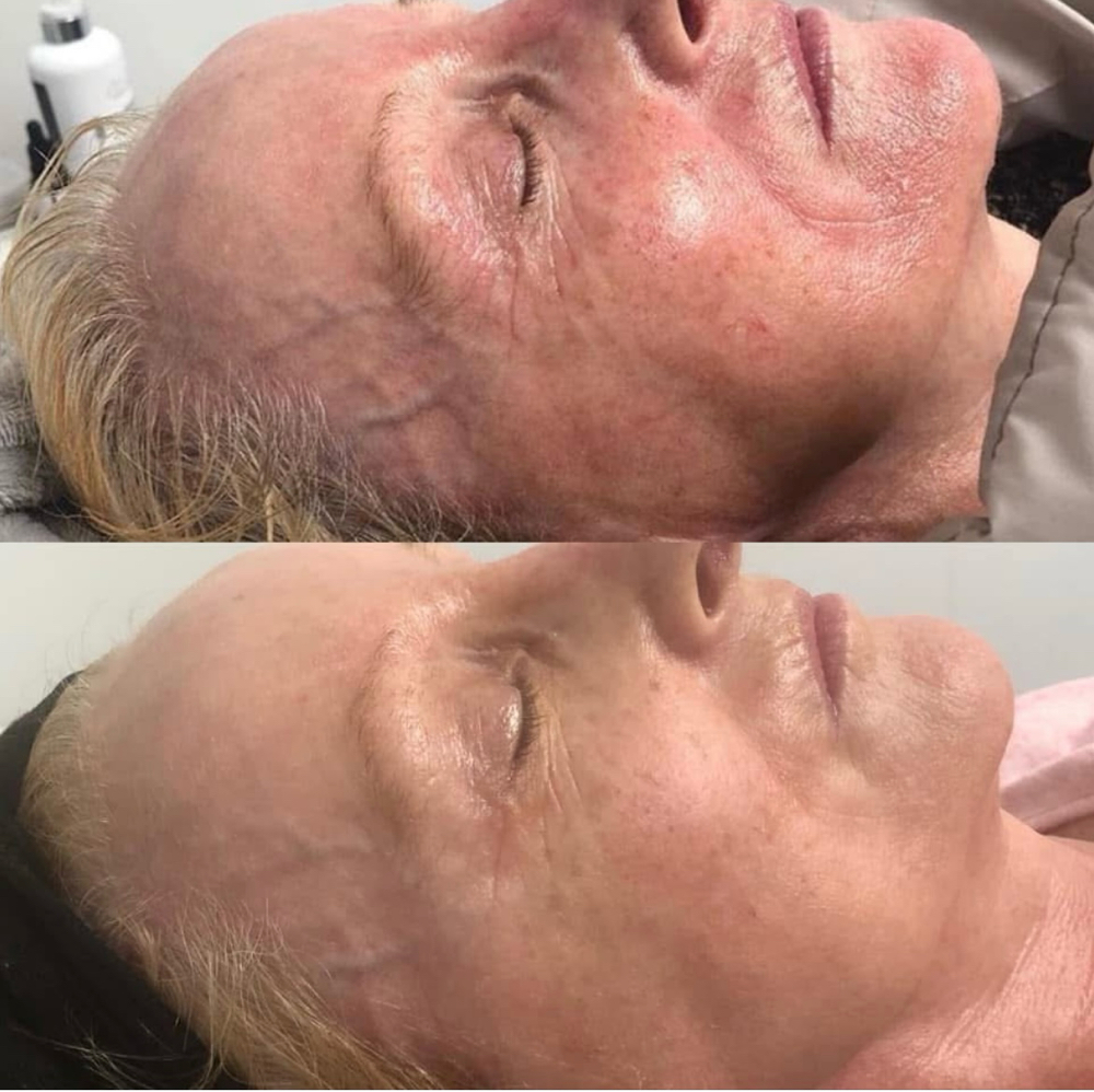 Lactic Peel + Facial