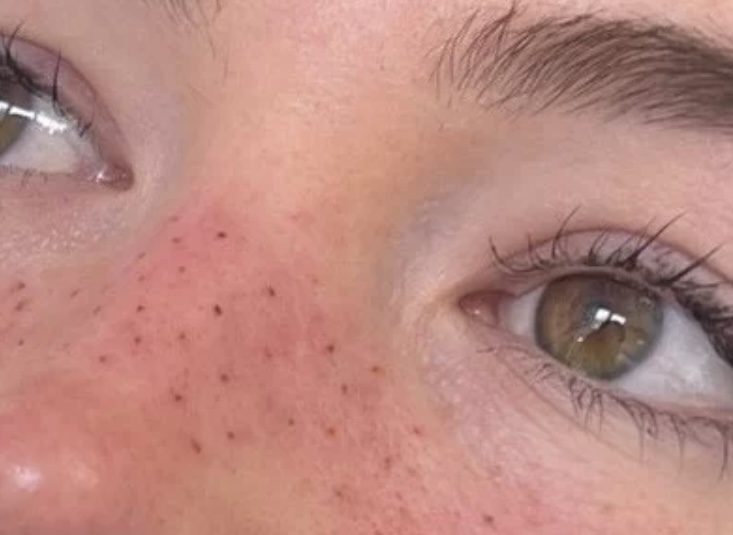 PMU Freckles Touch Up