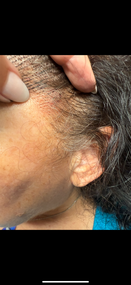 Scalp Micropigmentation