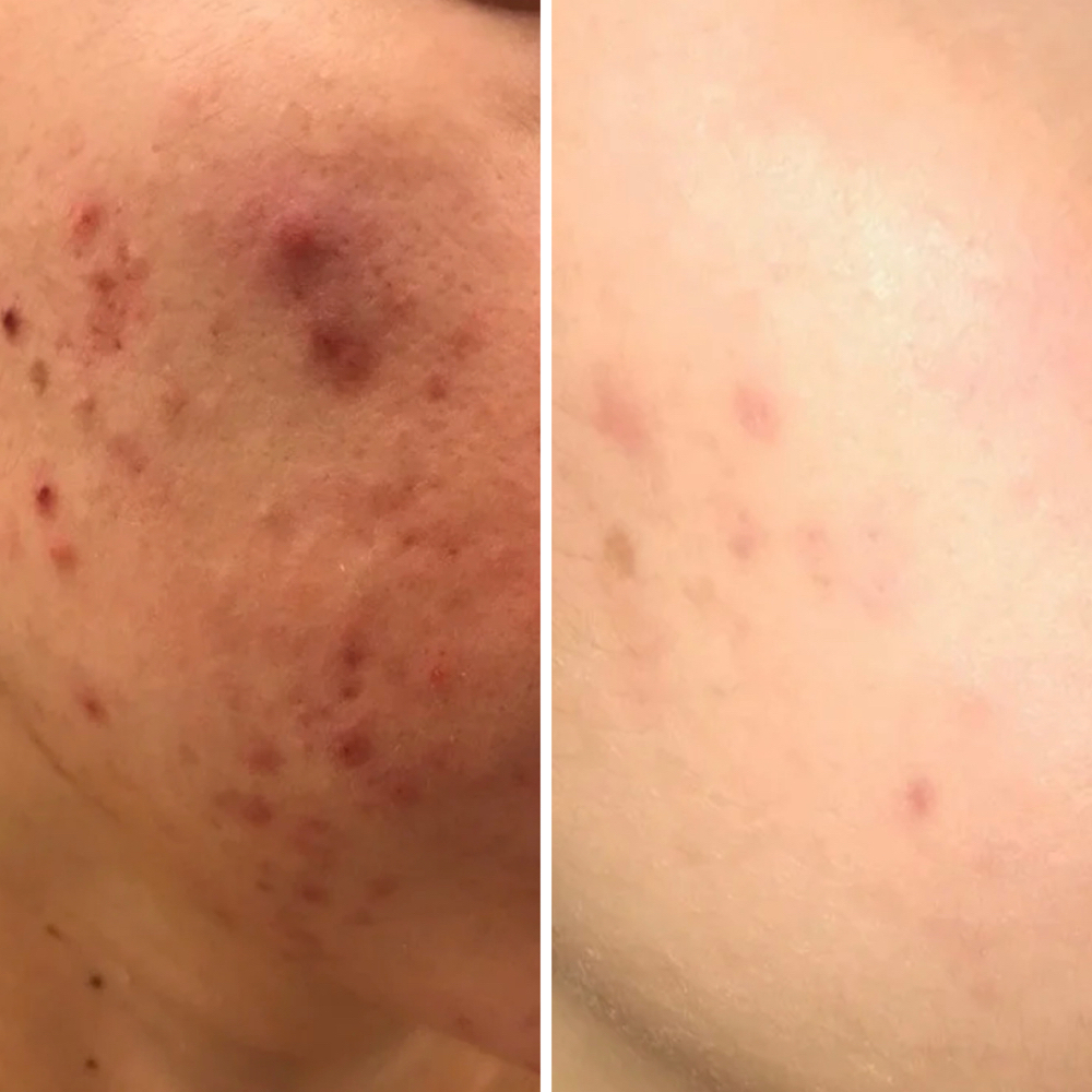 TCA Depigmentation Peel
