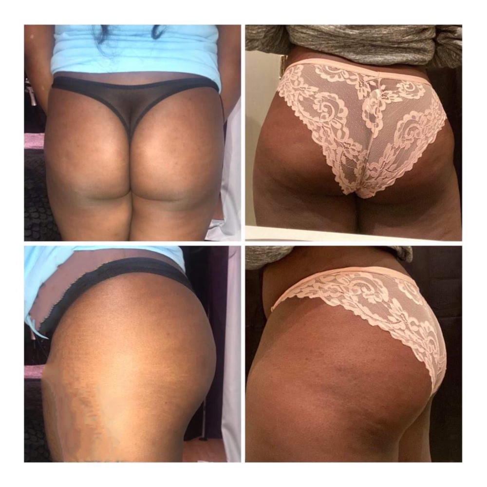Butt Injections
