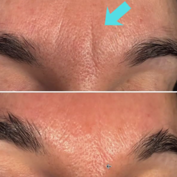 "No Needles" Facial at GloVolution LLC in Homosassa, FL