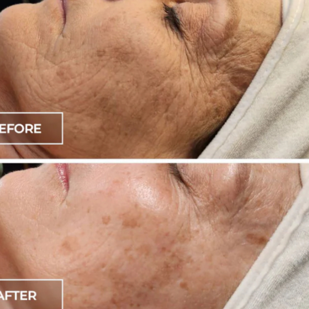 SWiTCH Rejuvination System at Loba Beauty Spa in Paterson, NJ