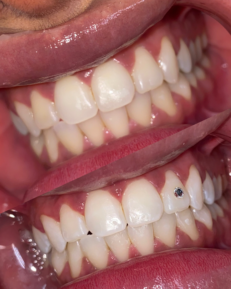 Icy Summer Express Teeth Whitening