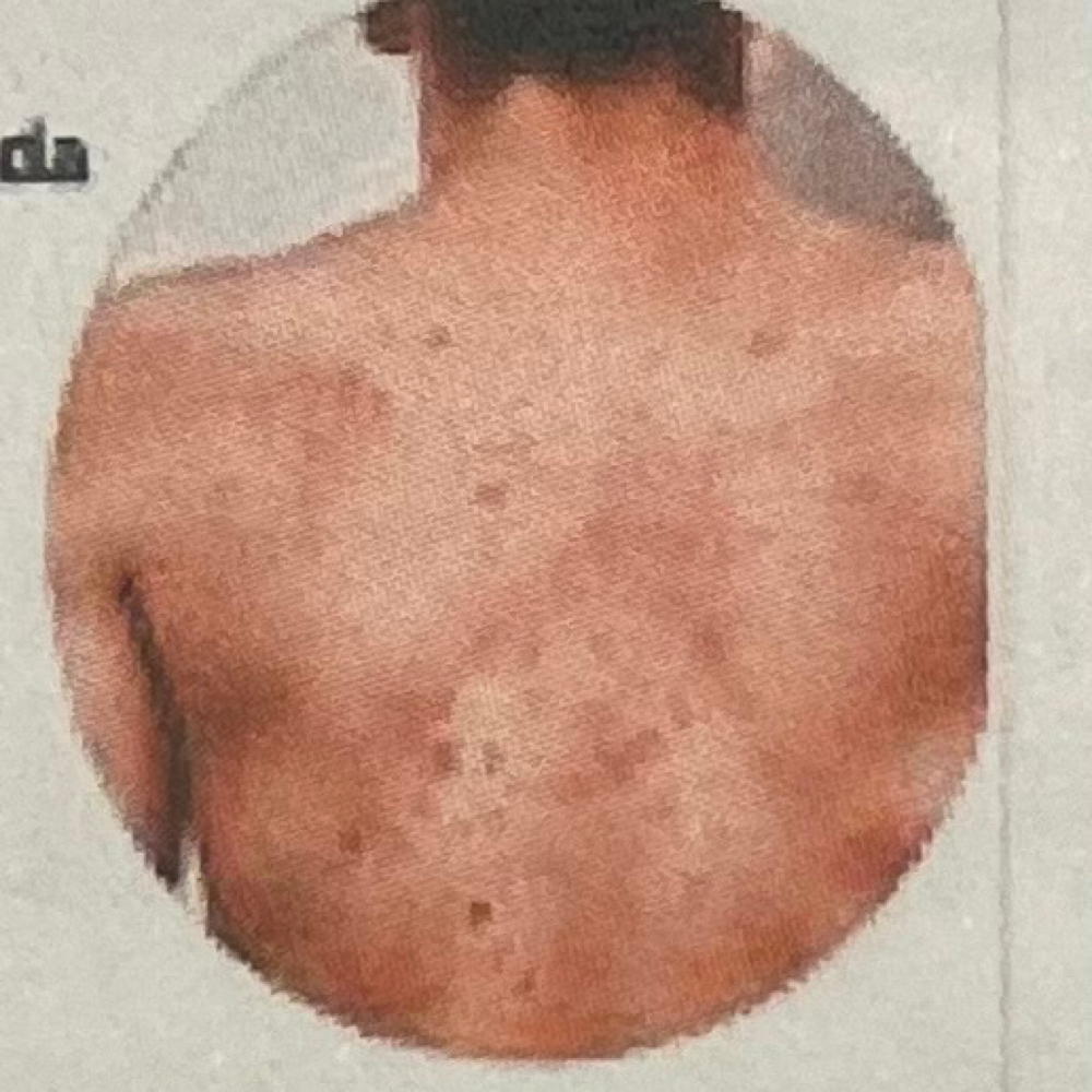 Terapia Acne Espalda at Glow by Ely & Mily Beauty Salon in Miami, FL