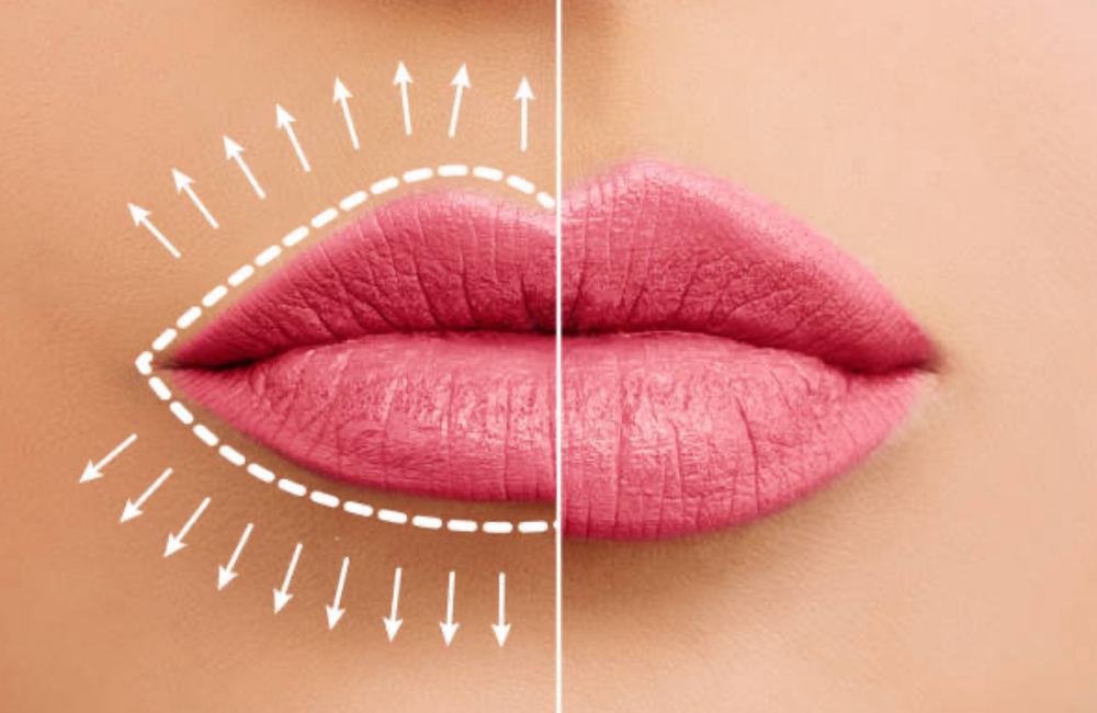 Lip Rejuvenation 💋