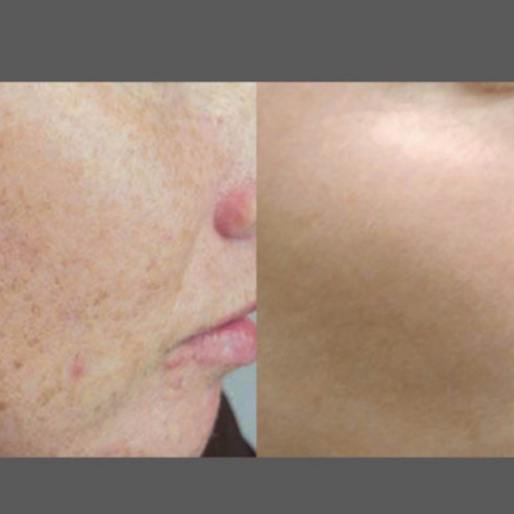 IPL (hands, Face, Chest) at LV Aesthetics LLC in Wellington, FL