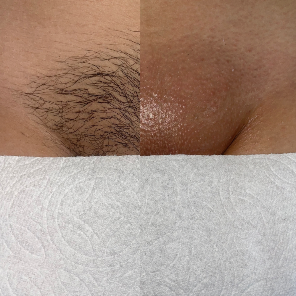 BRAZILIAN WAXING (Female Anatomy)