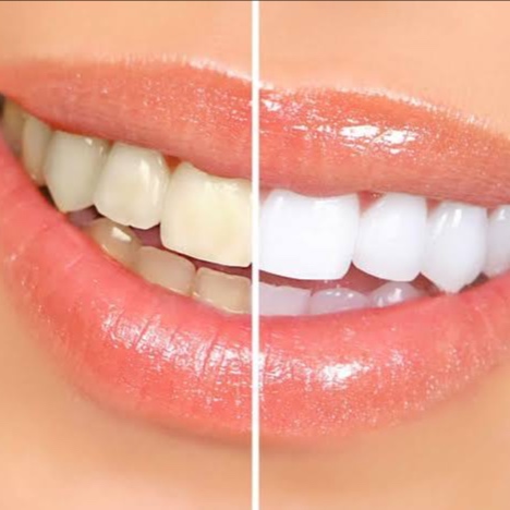 Teeth Whitening at Beauty Empowered in Layton, UT